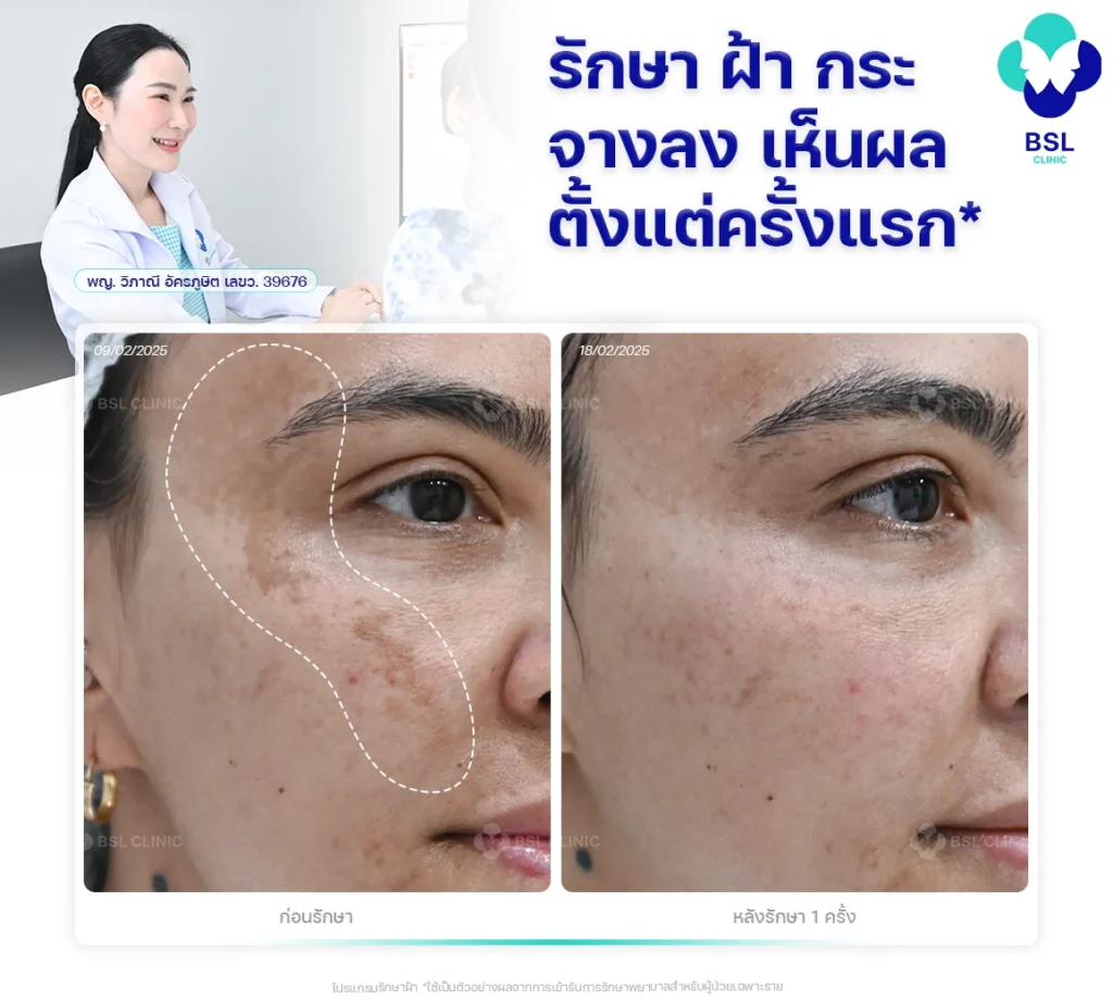 รักษาฝ้ากระจางลงเห็นผลตั้งแต่ครั้งแรก