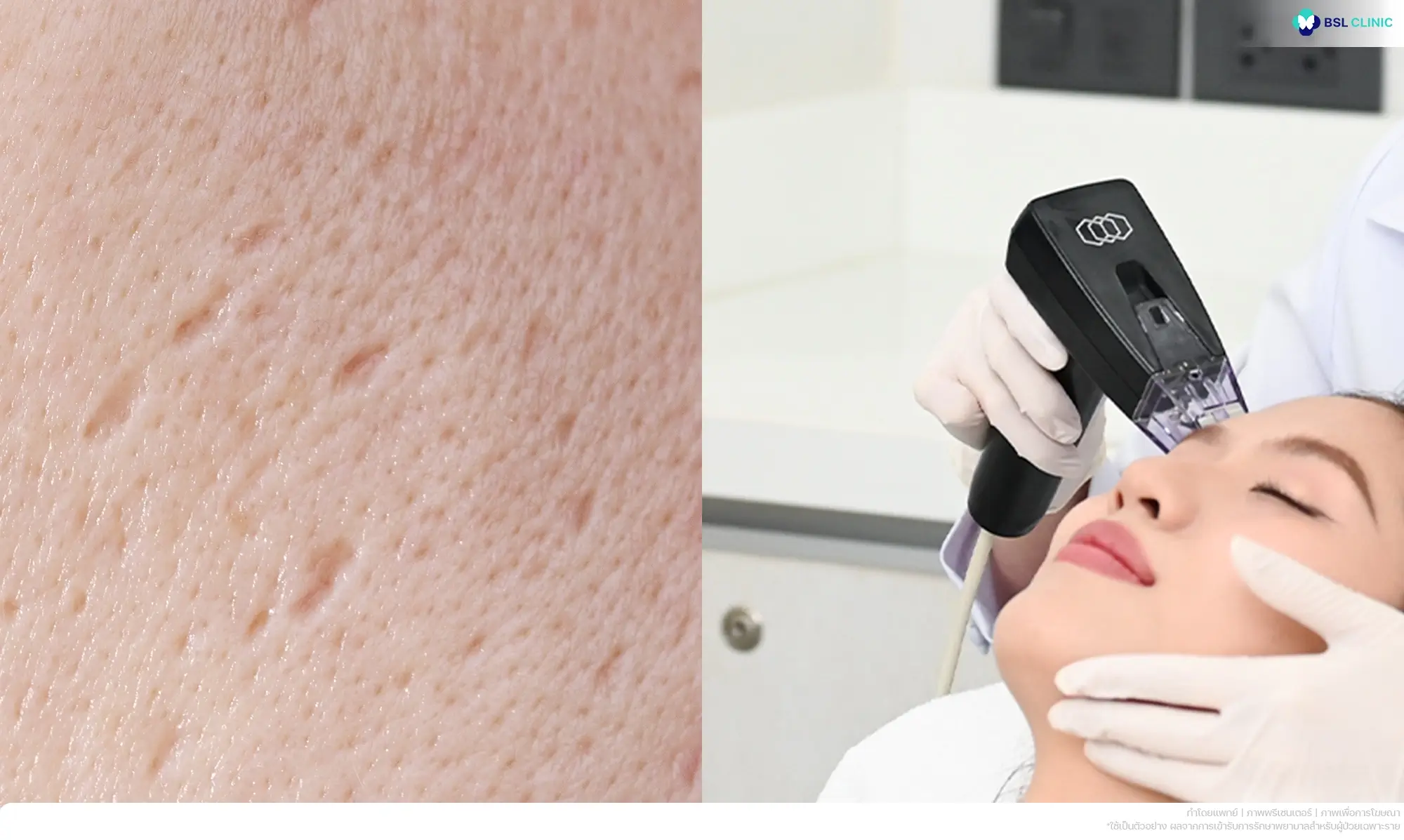 รักษาหลุมสิวแบบจิกด้วย Punch Excision, TCA CROSS และ Microneedling RF โดยแพทย์ที่ BSL Clinic