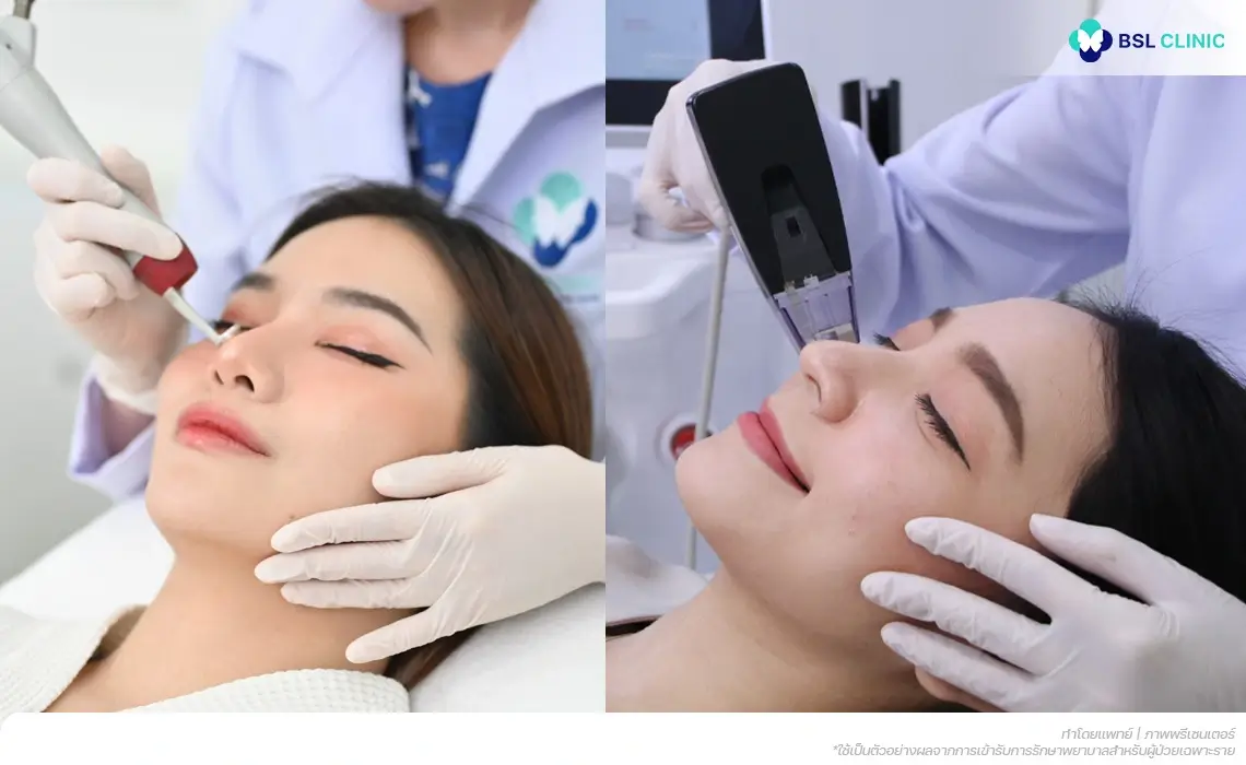 รักษาหลุมสิวแบบผสมผสาน Combined Acne Scar Treatment