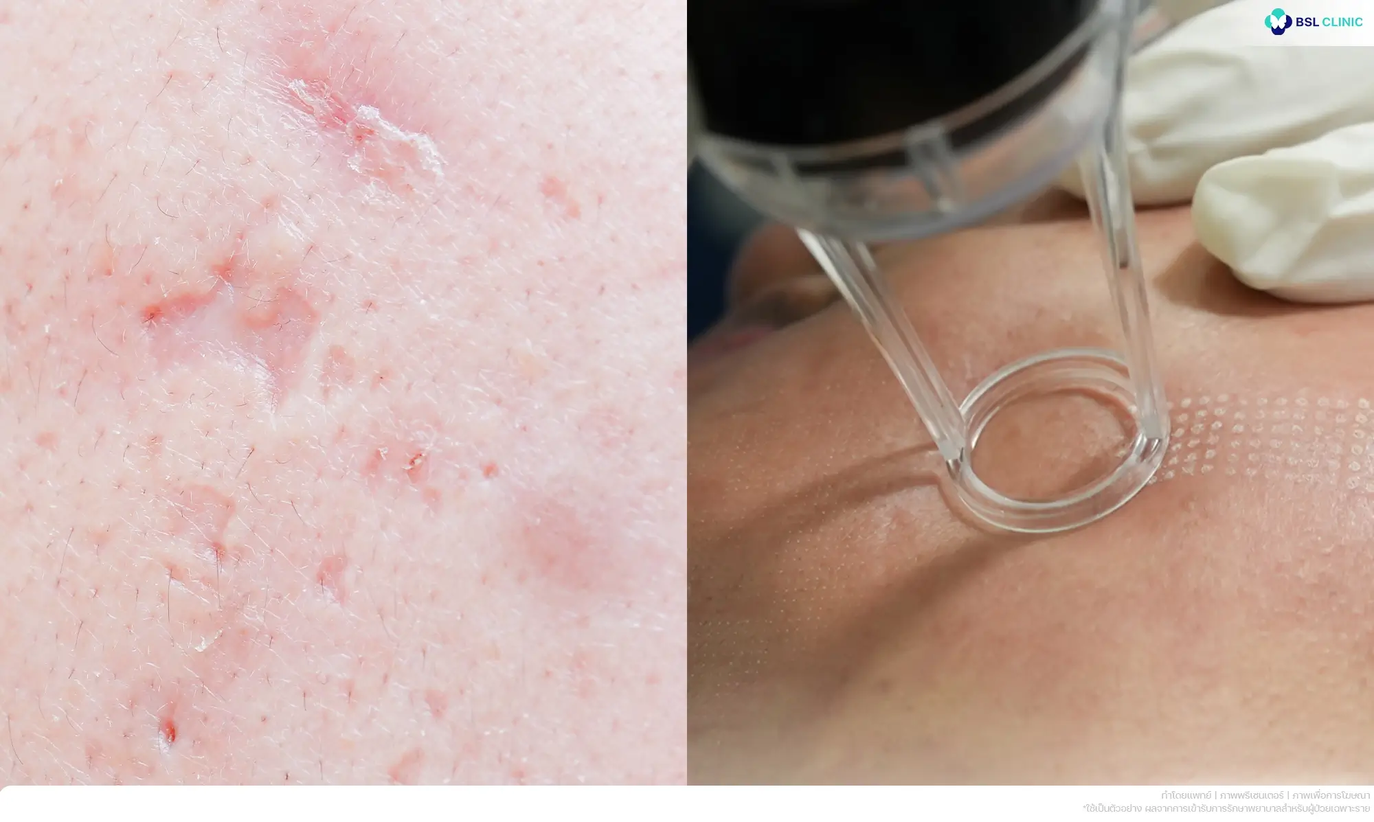 รักษาหลุมสิวแบบกล่องด้วยเลเซอร์หลุมสิว TCA และ Microneedling RF โดยแพทย์ผู้เชี่ยวชาญที่ BSL Clinic