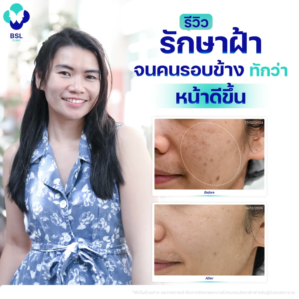 รีวิวรักษาฝ้า-จนคนรอบข้าง-ทักว่าหน้าดีขึ้น