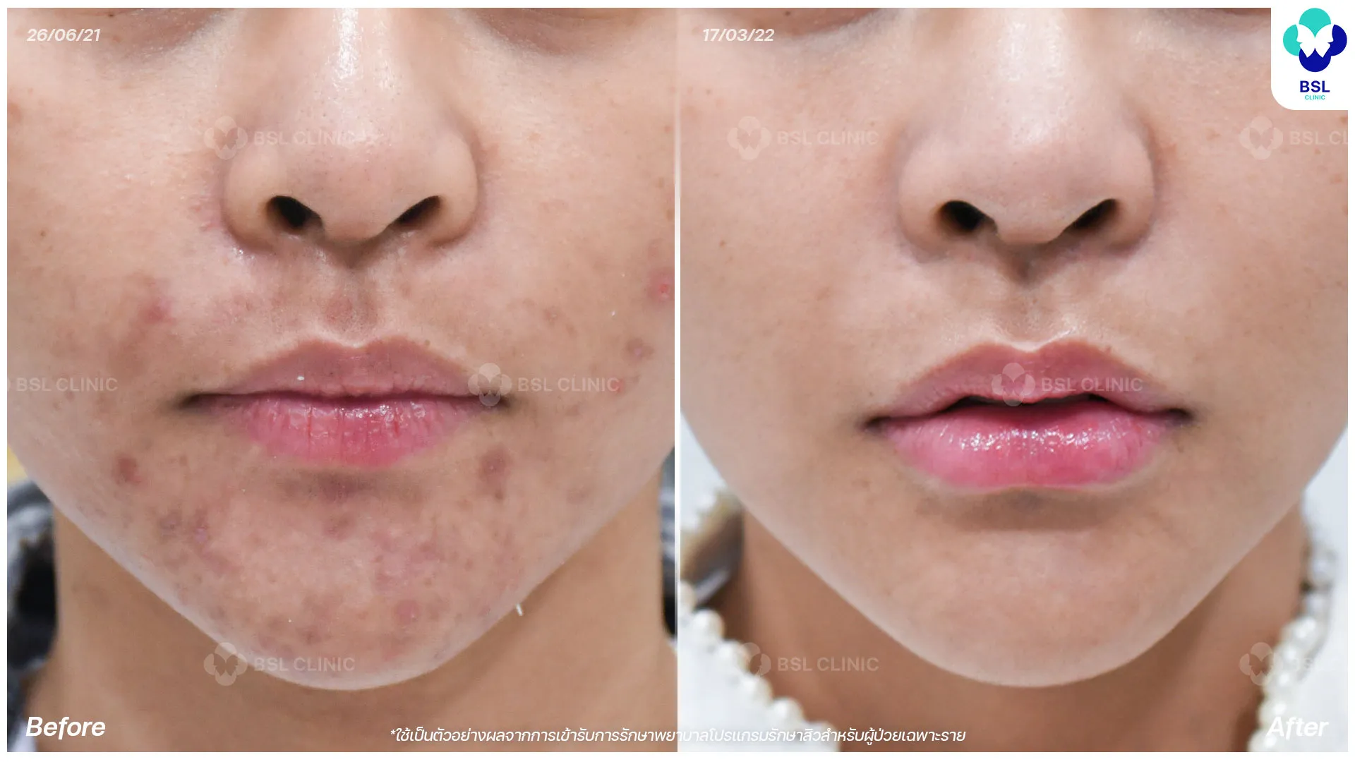 ภาพก่อนและหลังการรักษาสิวฮอร์โมน