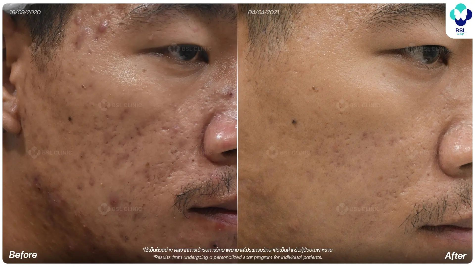 หลุมสิวรักษายังไง ผลก่อนและหลังการรักษาหลุมสิวด้วยแนวทางเฉพาะบุคคลที่ BSL Clinic