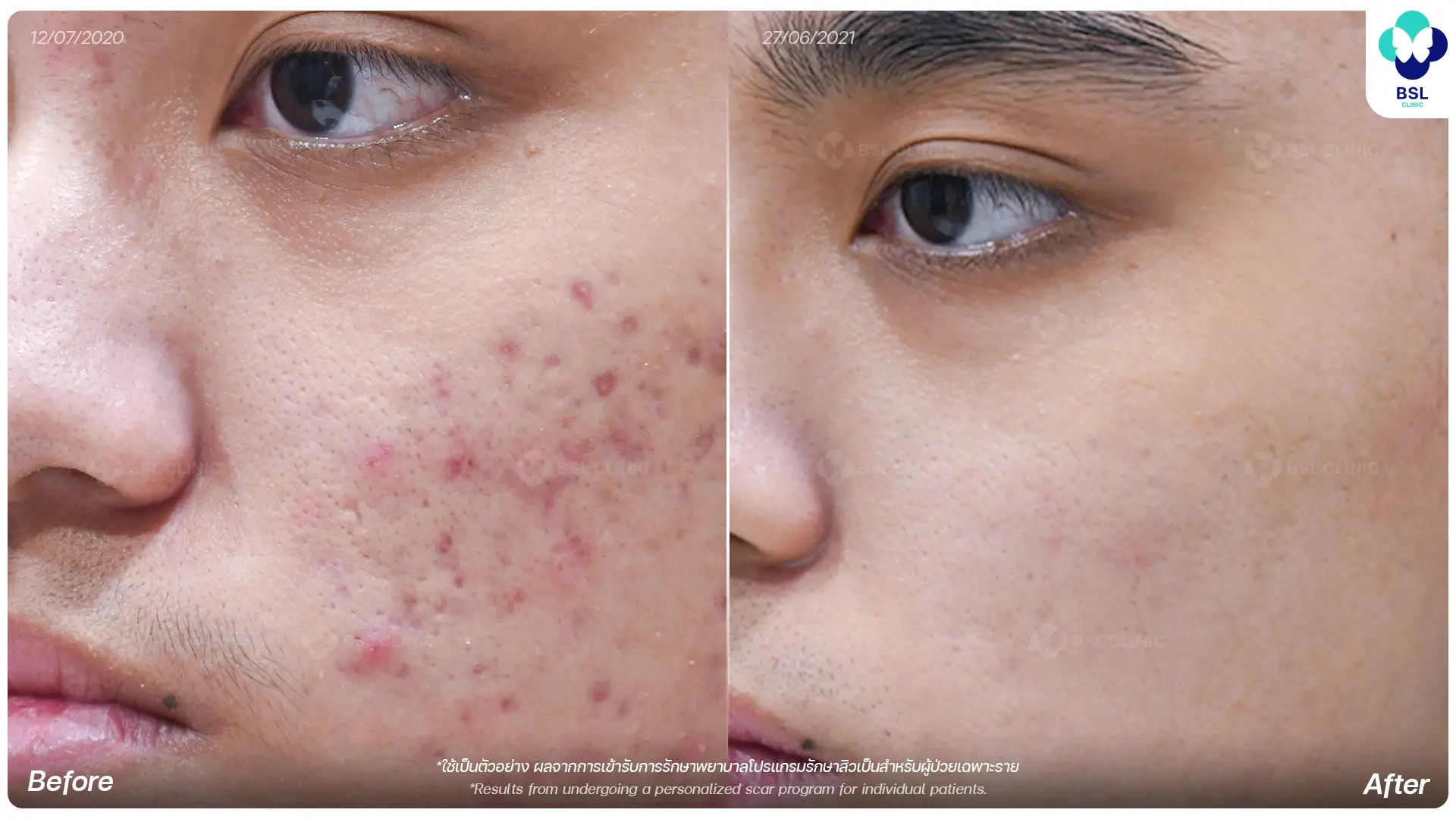 รีวิวรักษาหลุมสิวจากผู้รับบริการจริง ก่อนและหลังการรักษา ช่วยฟื้นฟูผิวให้เรียบเนียนที่ BSL Clinic