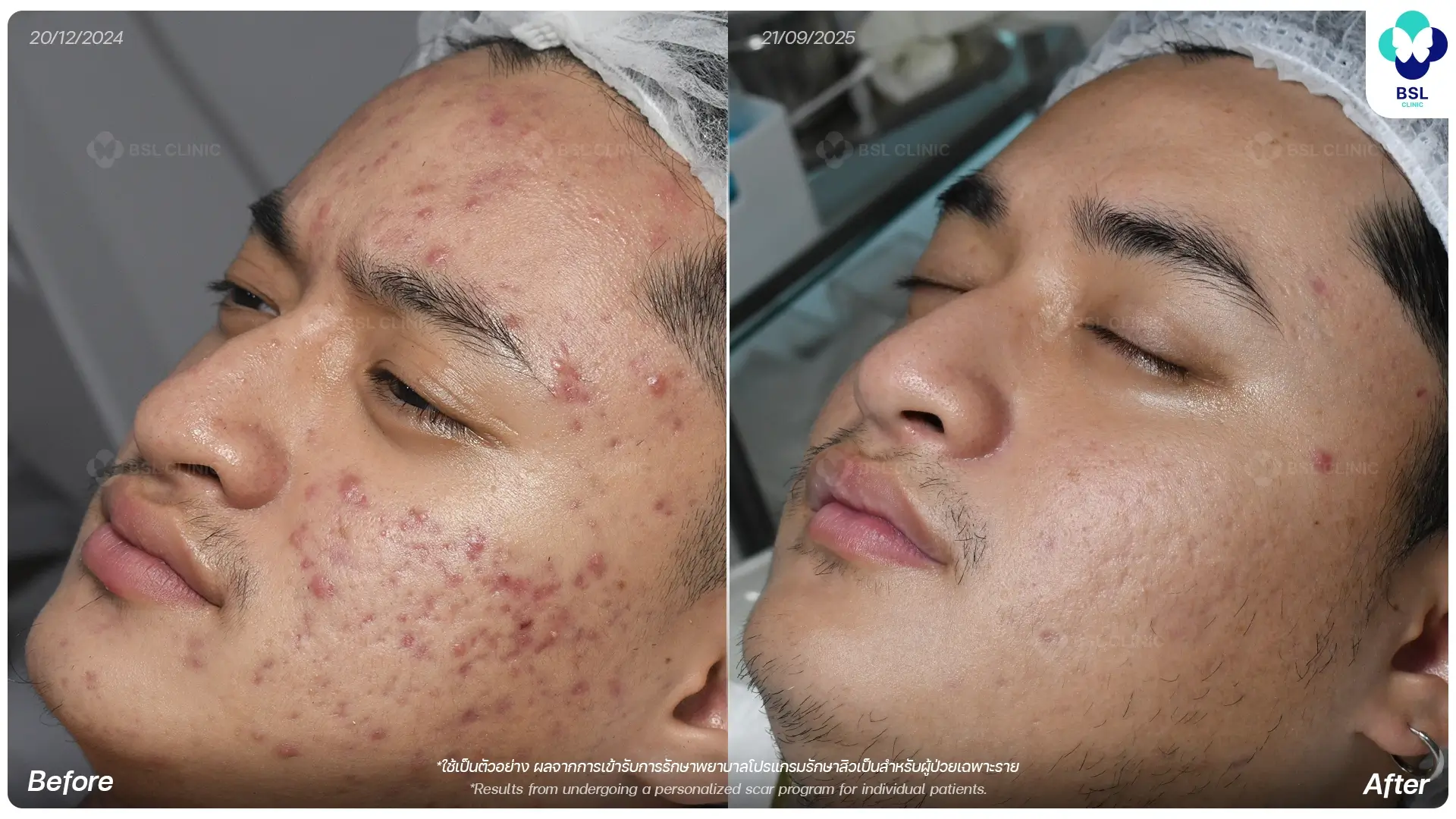 ตัวอย่างผลลัพธ์การรักษาหลุมสิว ก่อนและหลัง ช่วยให้หลุมสิวดูตื้นขึ้น โดยแพทย์ผู้เชี่ยวชาญที่ BSL Clinic