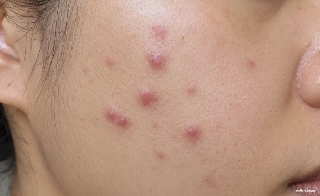 สิวไม่มีหัว-นูนๆ-สิวอักเสบไม่มีหัว