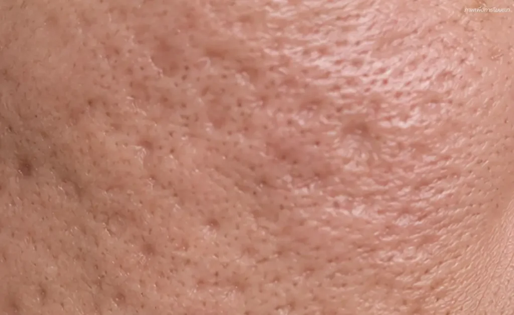 หลุมสิว Acne-Scars