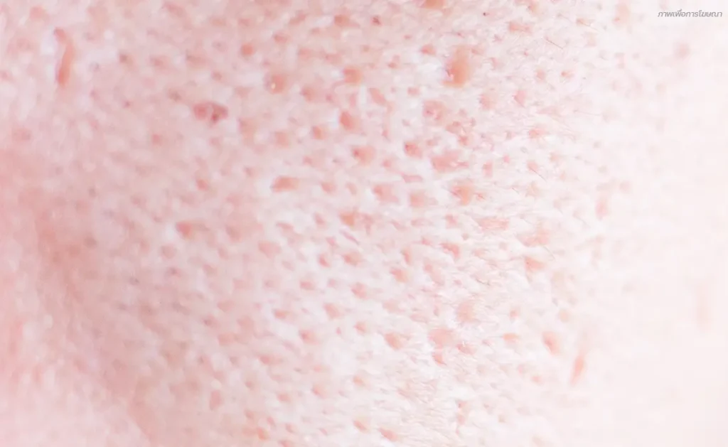 หลุมสิวแบบจิก Ice Pick Scar