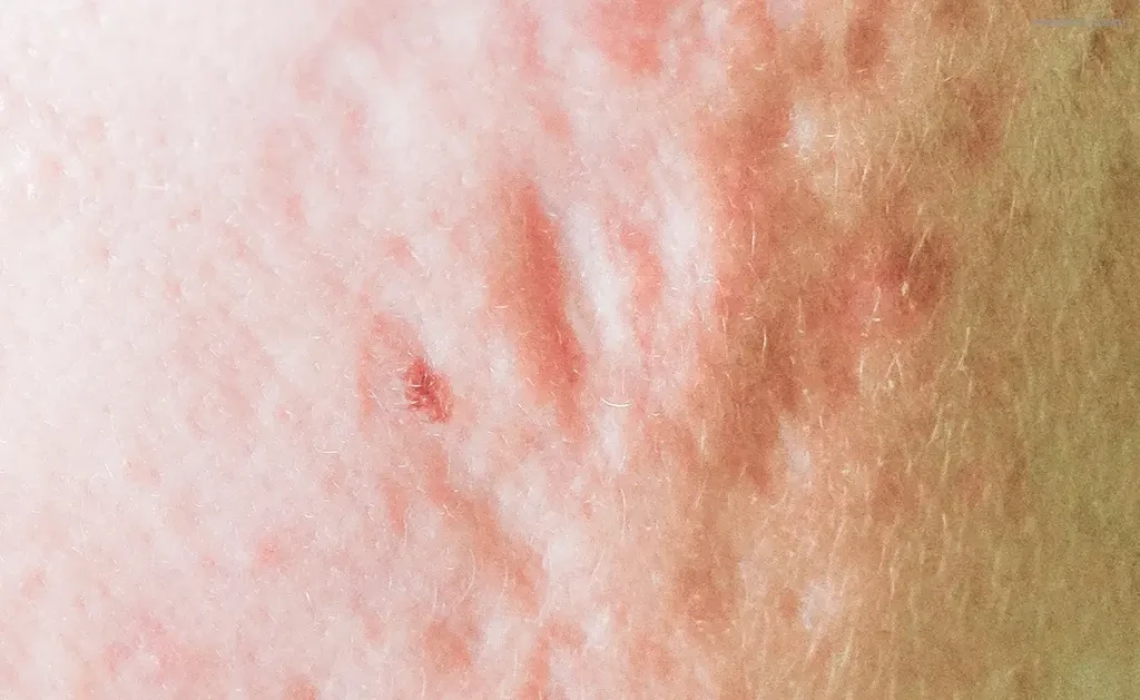 หลุมสิวแบบแอ่งกระทะ Rolling Scar