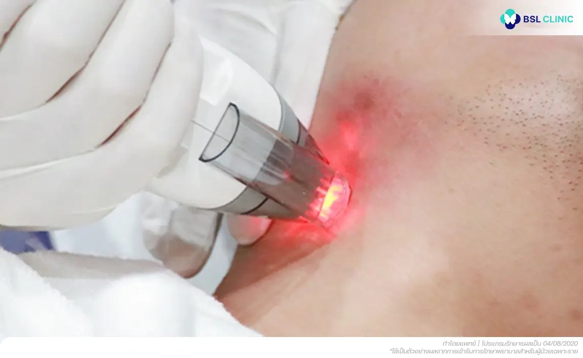 เลเซอร์แผลเป็นนูนจากสิว hypertrophic-acne-scar-laser-treatment
