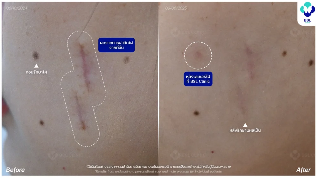 รีวิวเลเซอร์ไฝ & ผ่าตัดไฝ
