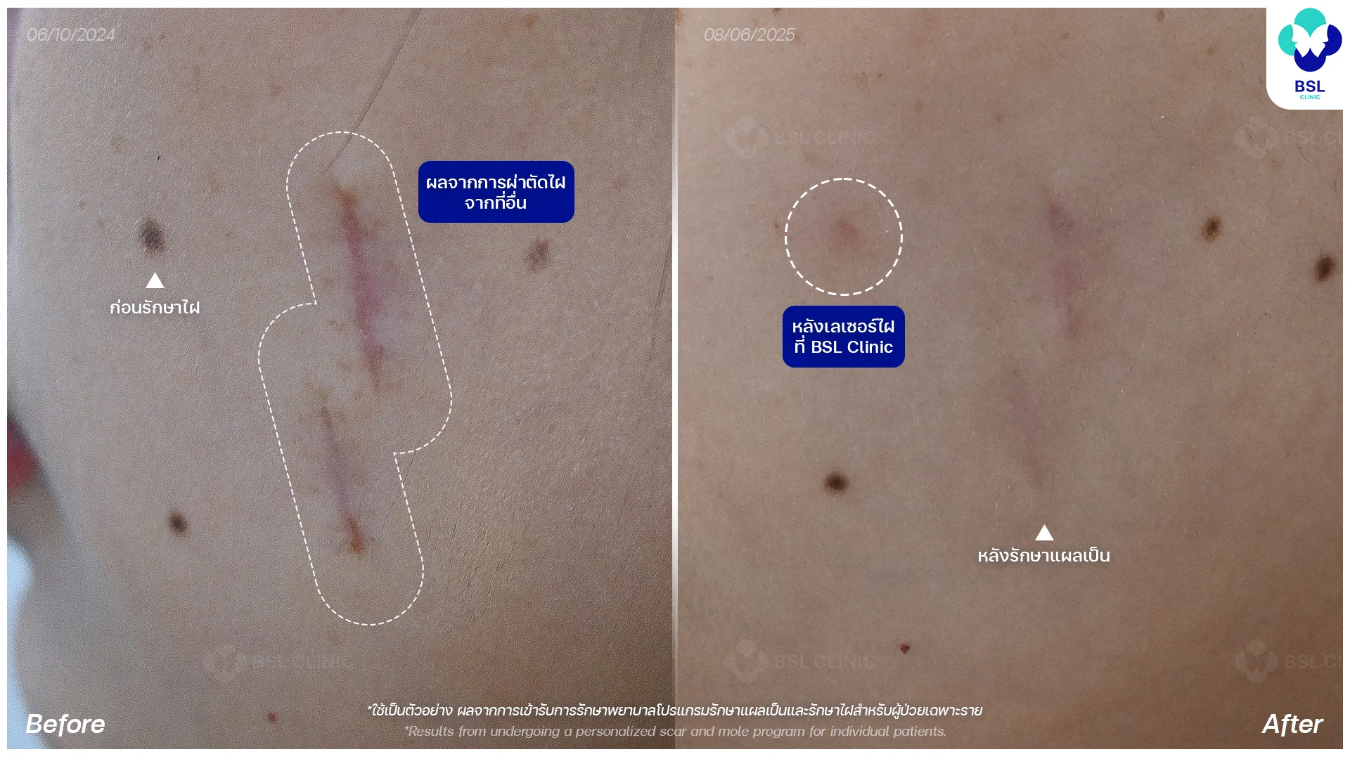 รีวิวเลเซอร์ไฝ & ผ่าตัดไฝ
