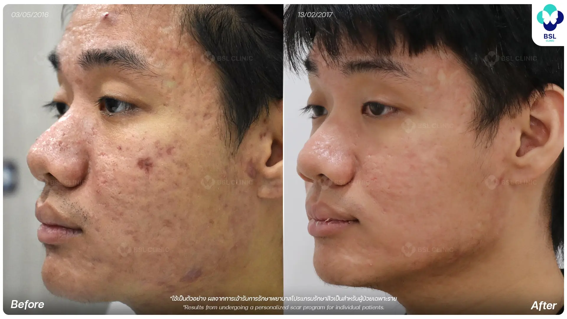 ผลก่อนและหลังรักษาหลุมสิวที่ BSL Clinic รีวิวรักษาหลุมสิวและตัวอย่างผลลัพธ์จากผู้รับบริการจริง