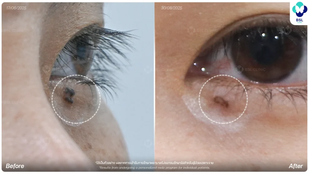 mole-under-eye-before-after-co2-laser-04