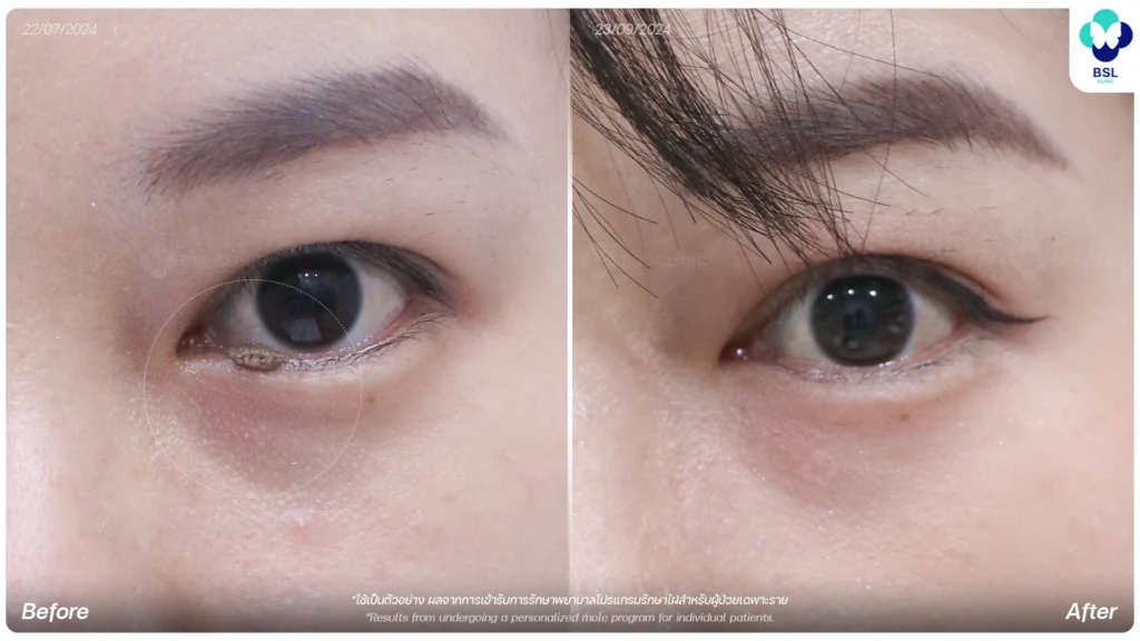 ก่อนและหลังรักษาไฝขอบตา คนไข้ต่างชาติ BSL Clinic