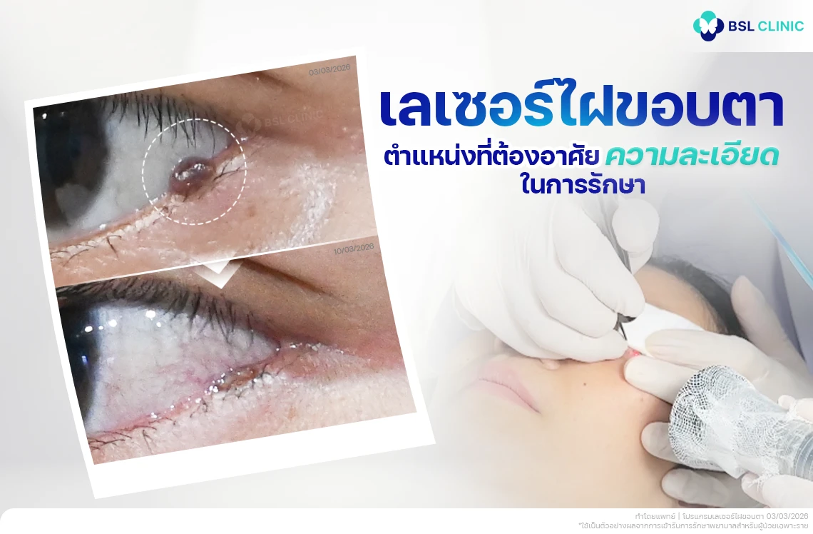 รักษาไฝใต้ตา ไฝบนหน้า ด้วย CO2 Laser ดูแลโดยแพทย์ที่ BSL Clinic