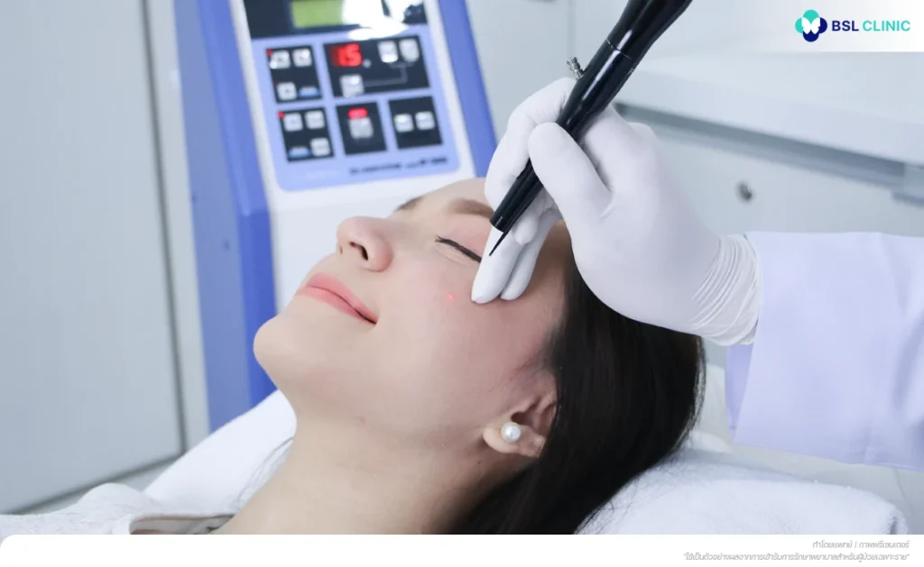 แพทย์ BSL ดูแลไฝใต้ตาชิดขอบตาด้วย CO2 Laser