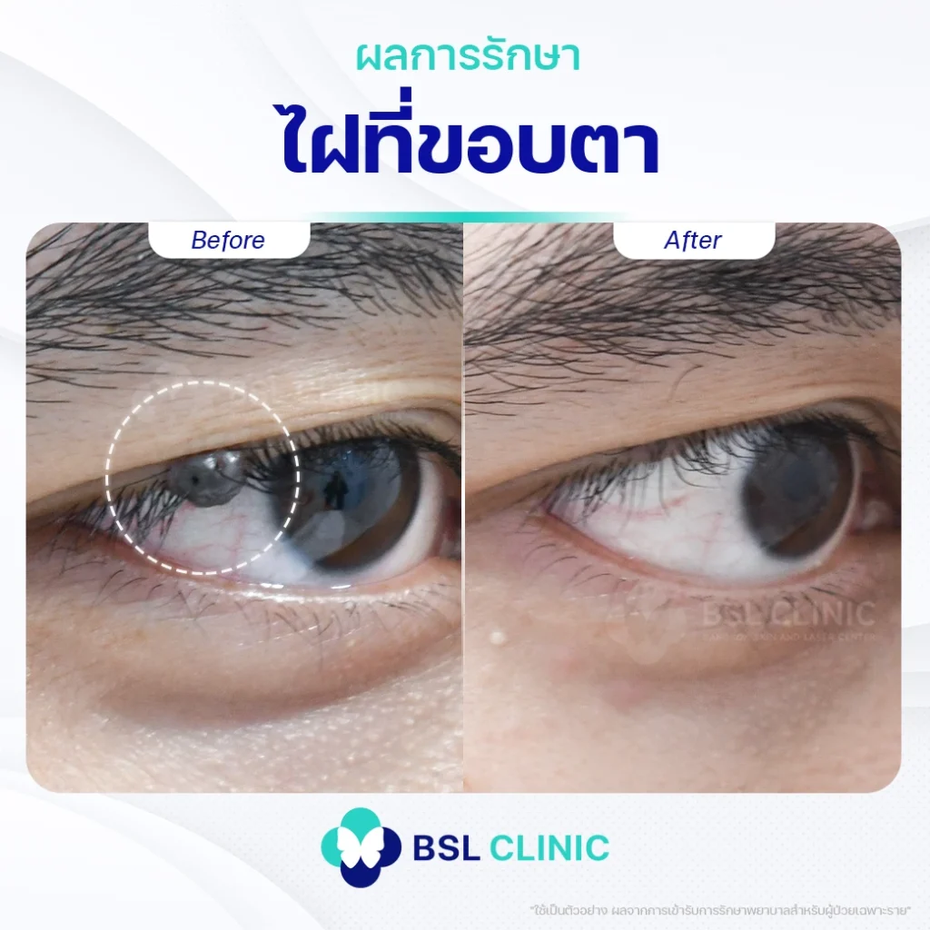 ภาพผลการเลเซอร์ไฝใต้ตา01