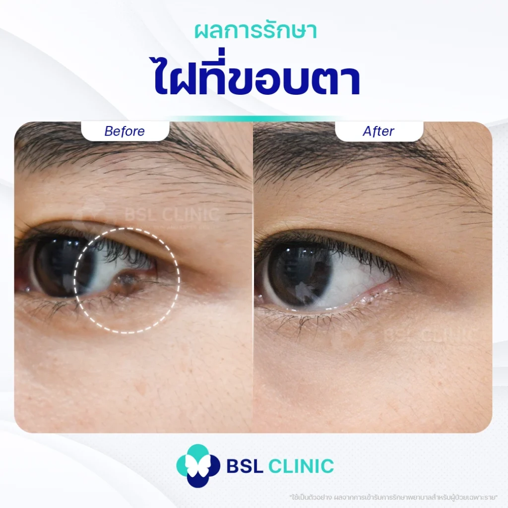 ภาพผลการเลเซอร์ไฝใต้ตา02