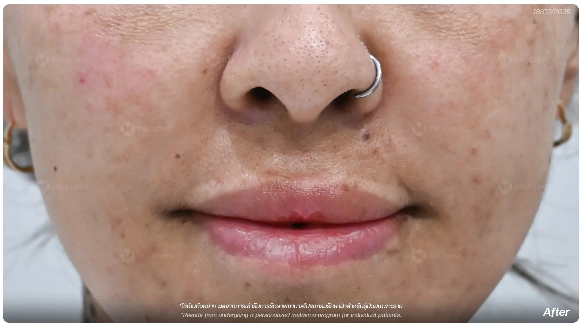 หลังรักษาฝ้า after-melasma-treatment