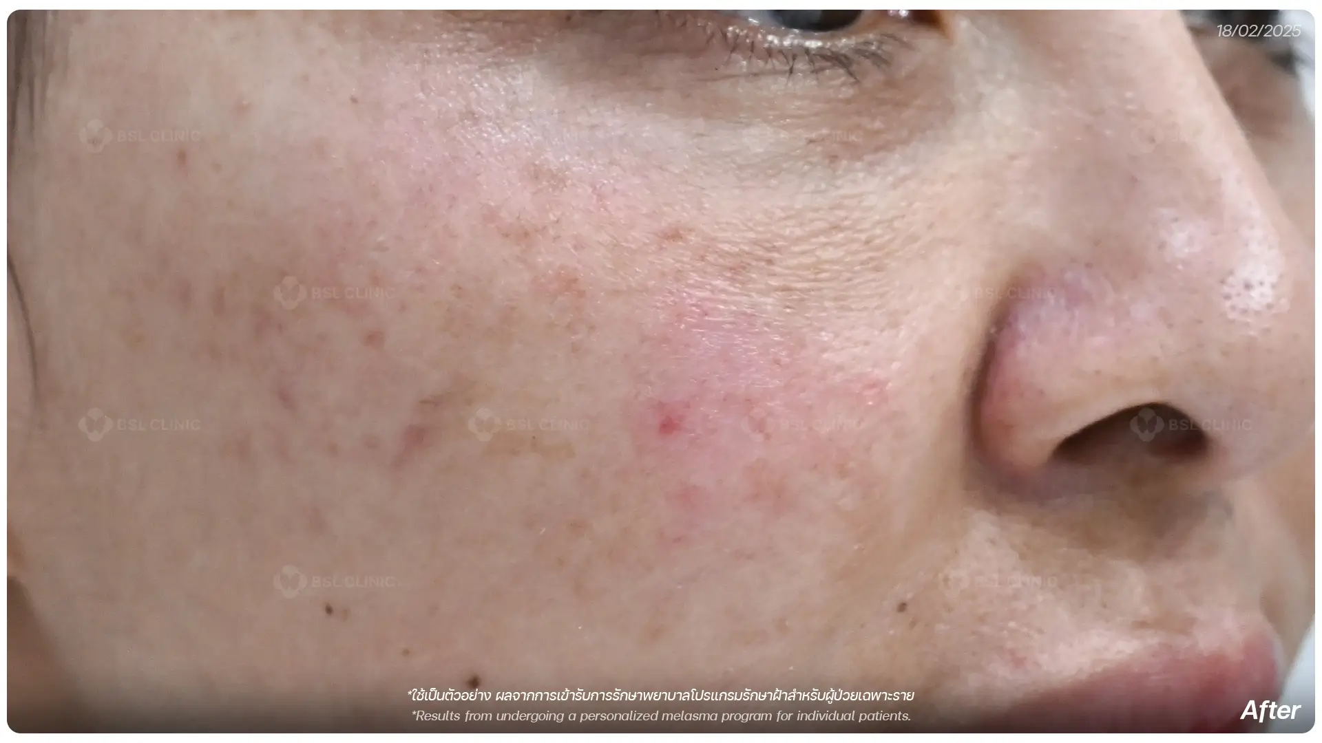 หลังรักษาฝ้า After Melasma Treatment