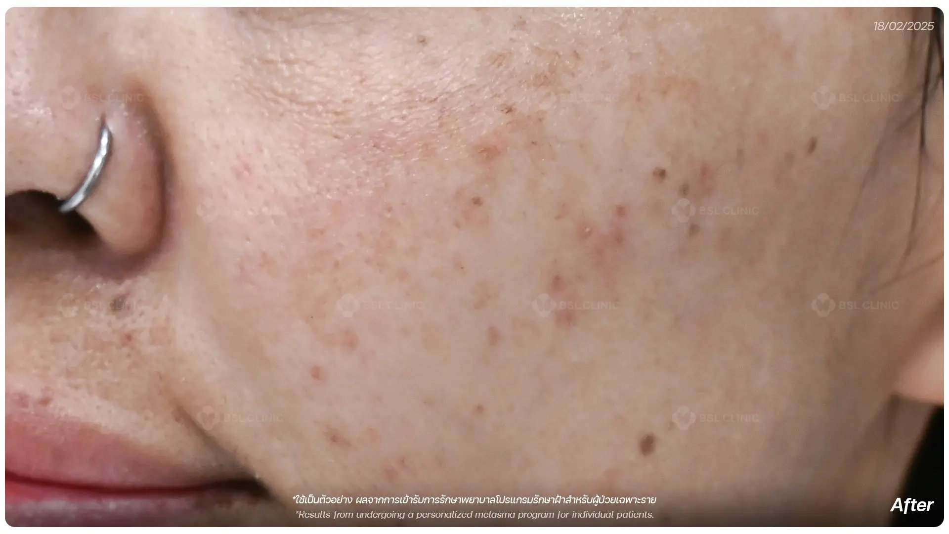 หลังรักษาฝ้า After Melasma Treatment