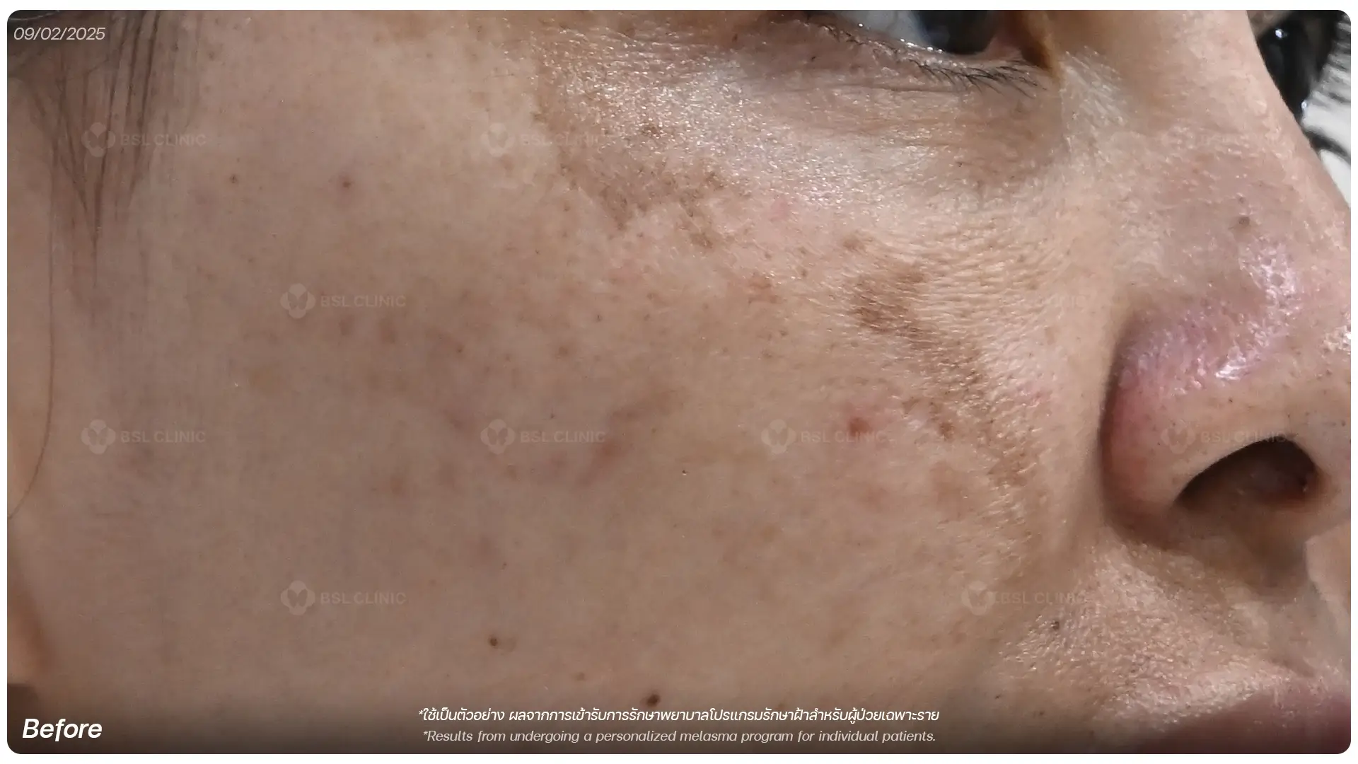ก่อนรักษาฝ้า After Melasma Treatment