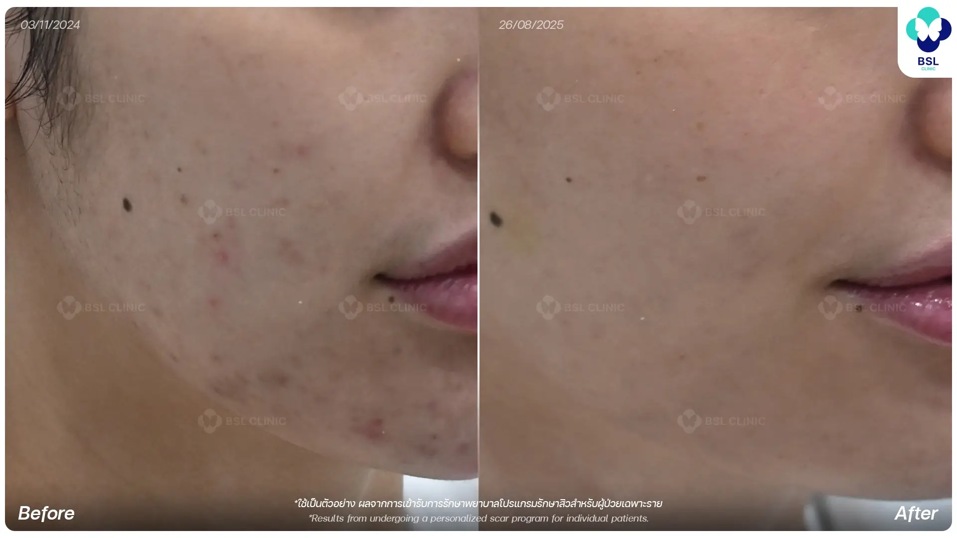 Acne-ชวัลนุช-อุชชิน-671046-A (1)