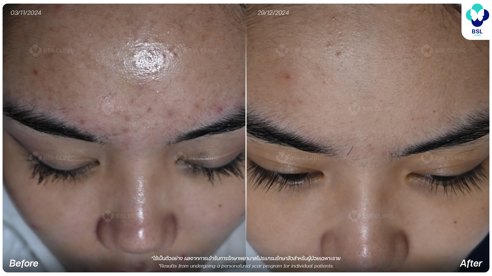 Acne-ชวัลนุช-อุชชิน-671046-A