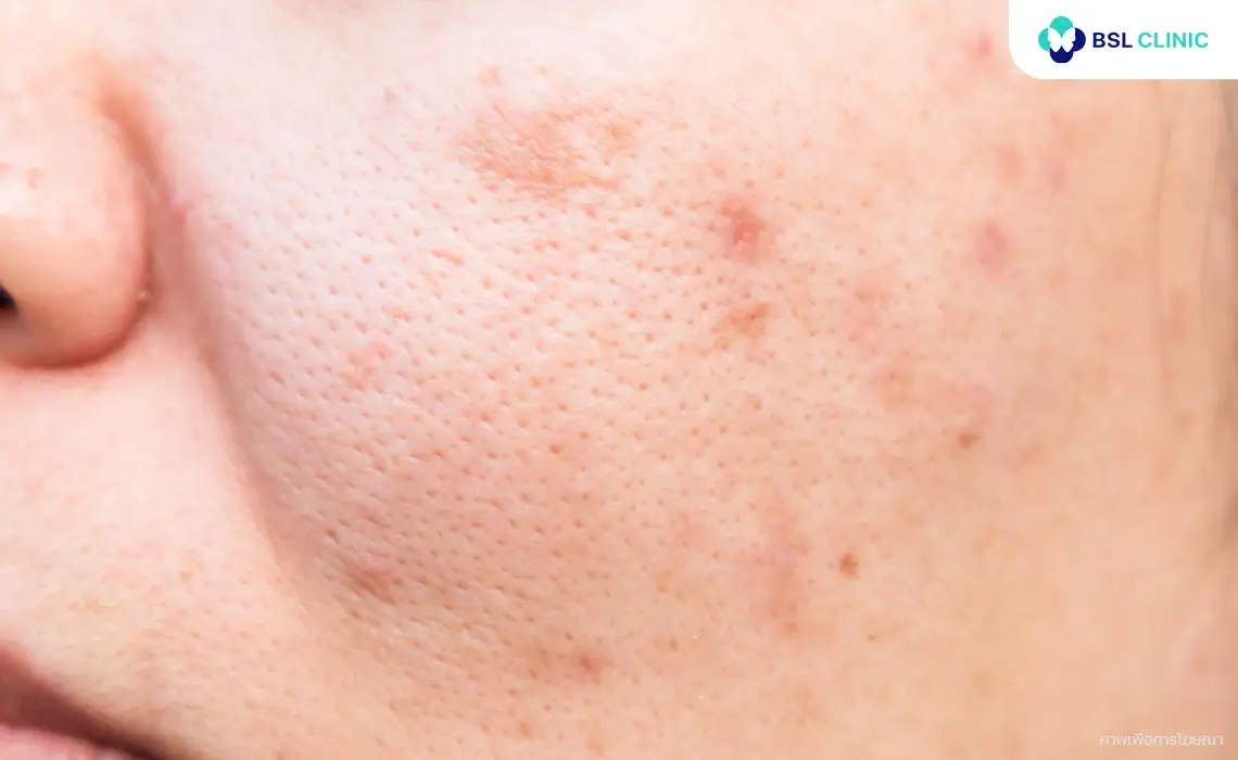 PicoWay รักษาฝ้า PicoWay Pigmentation