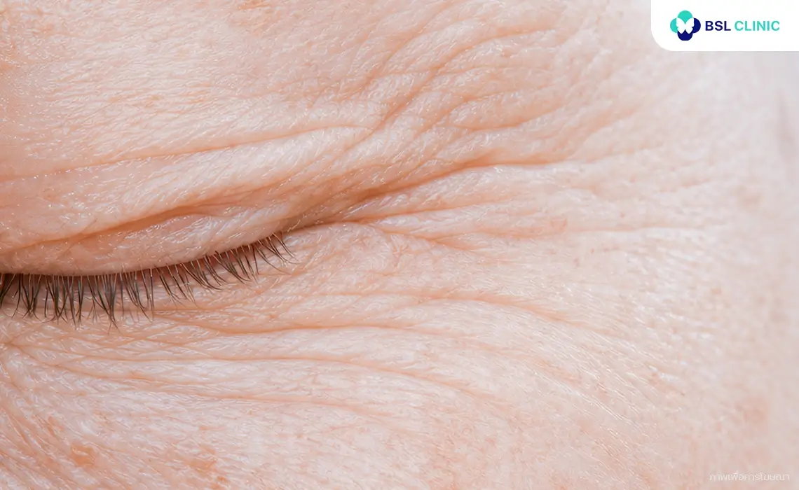 PicoWay ลดริ้วรอย picoway wrinkles reduction