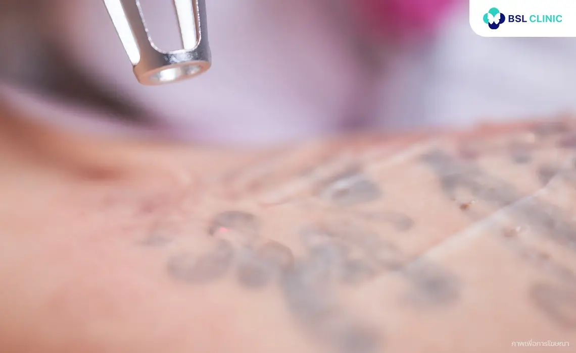 PicoWay ลบรอยสัก PicoWay Tattoo Removal