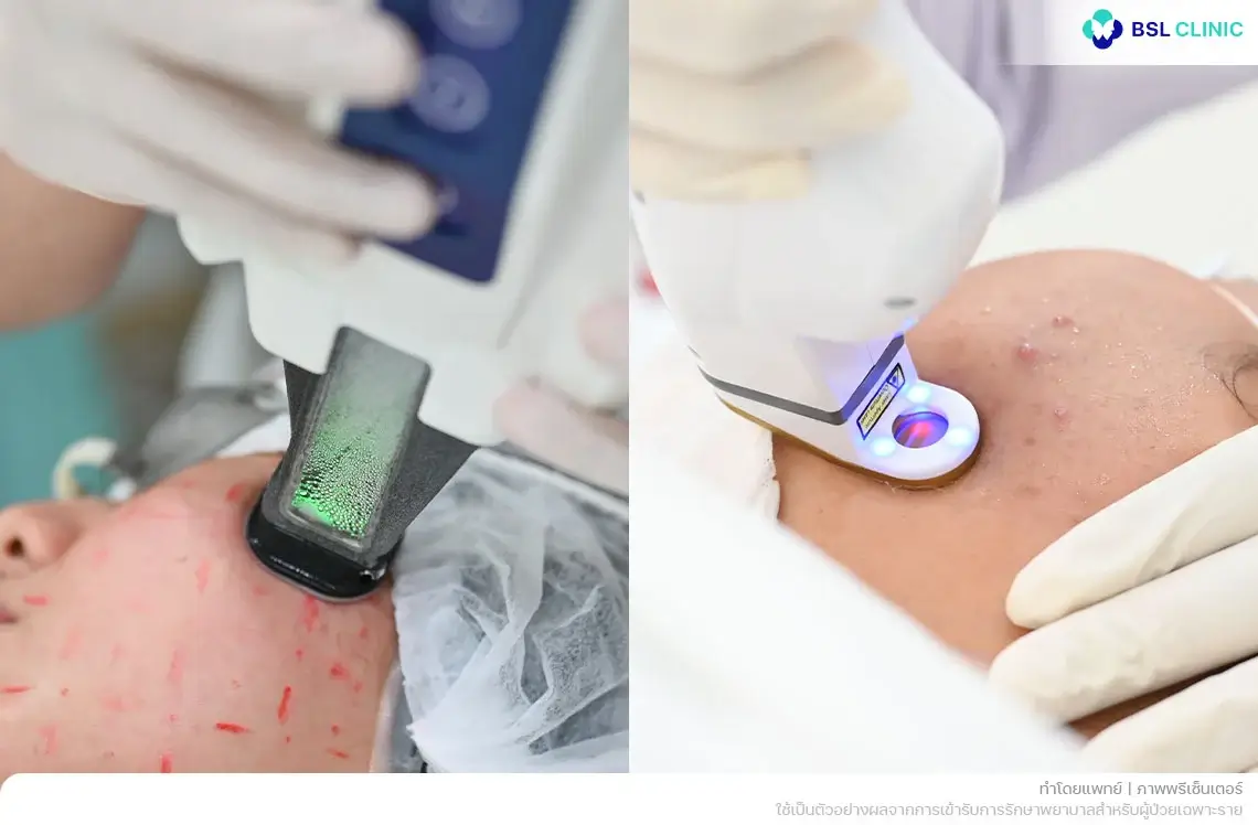 Accure AviClear Laser