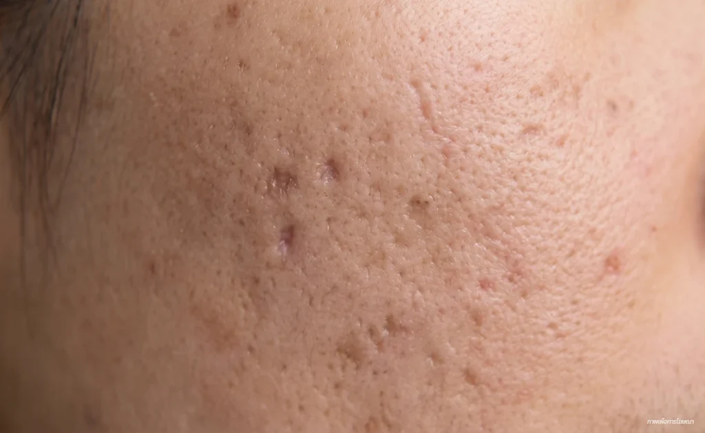 หลุมสิว acne-scar