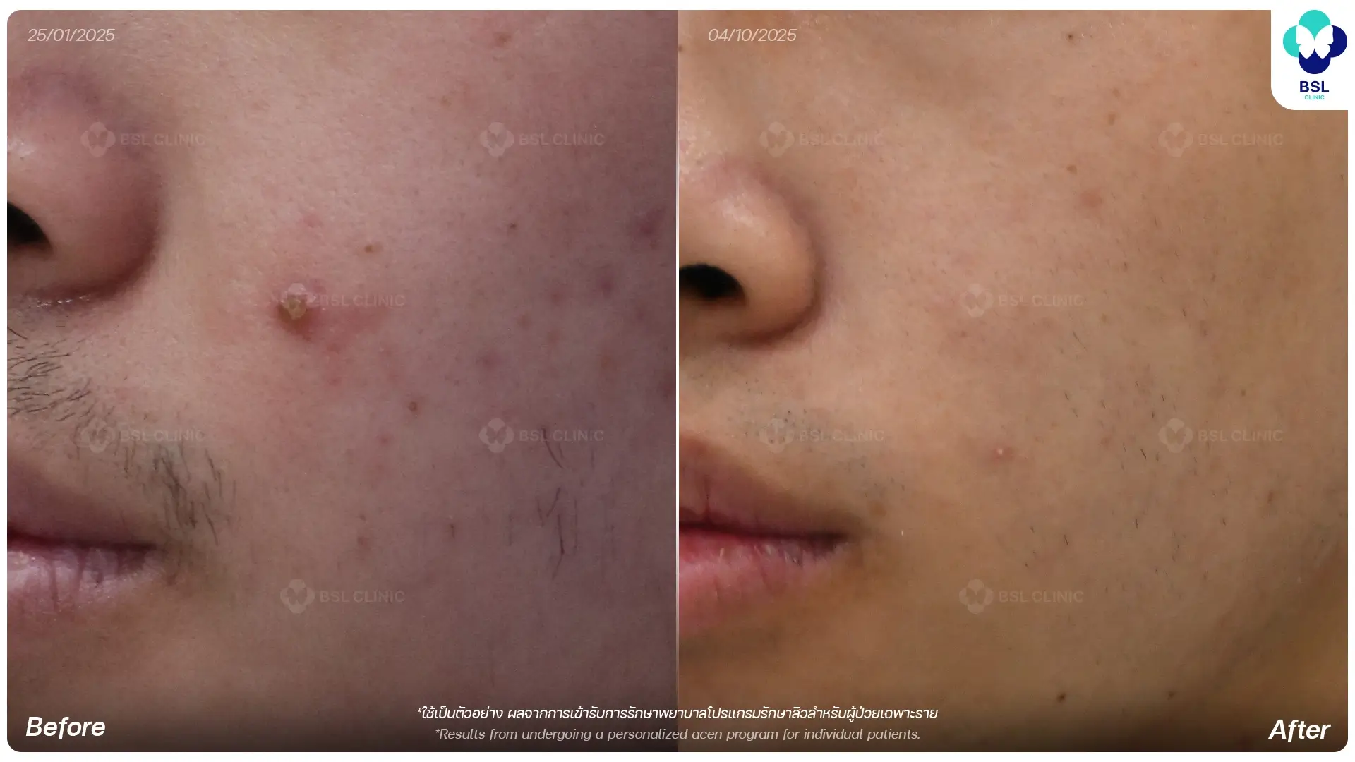 before after 6680103 L ปีย์จักร รักษาสิว