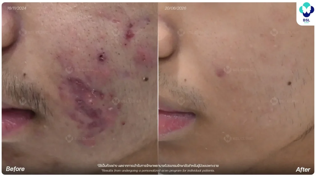 ภาพ Before After การรักษาสิวและรอยสิว