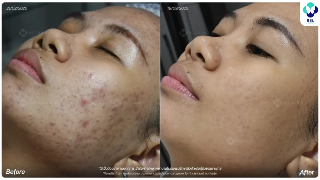 ภาพก่อนและหลังรักษาสิวจากผู้รับบริการจริง