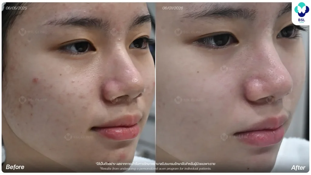 รีวิวผลการรักษาสิวก่อนและหลังจาก BSL Clinic