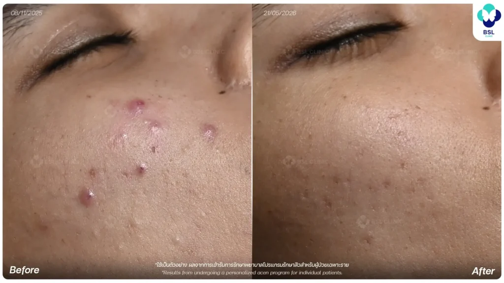 รีวิวรักษาสิวก่อนและหลัง ผลลัพธ์ผิวที่ดูดีขึ้น