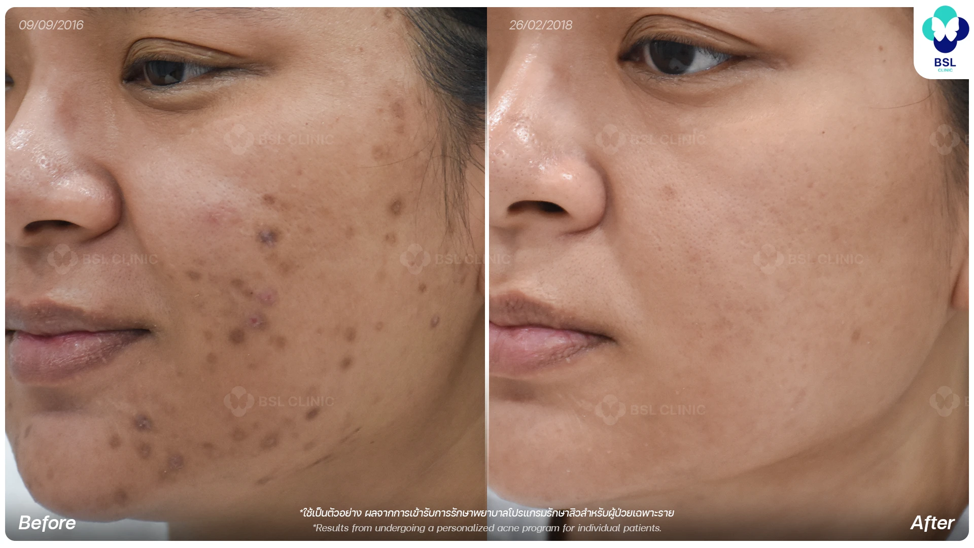 before after รักษารอยดำ จุดด่างดำ