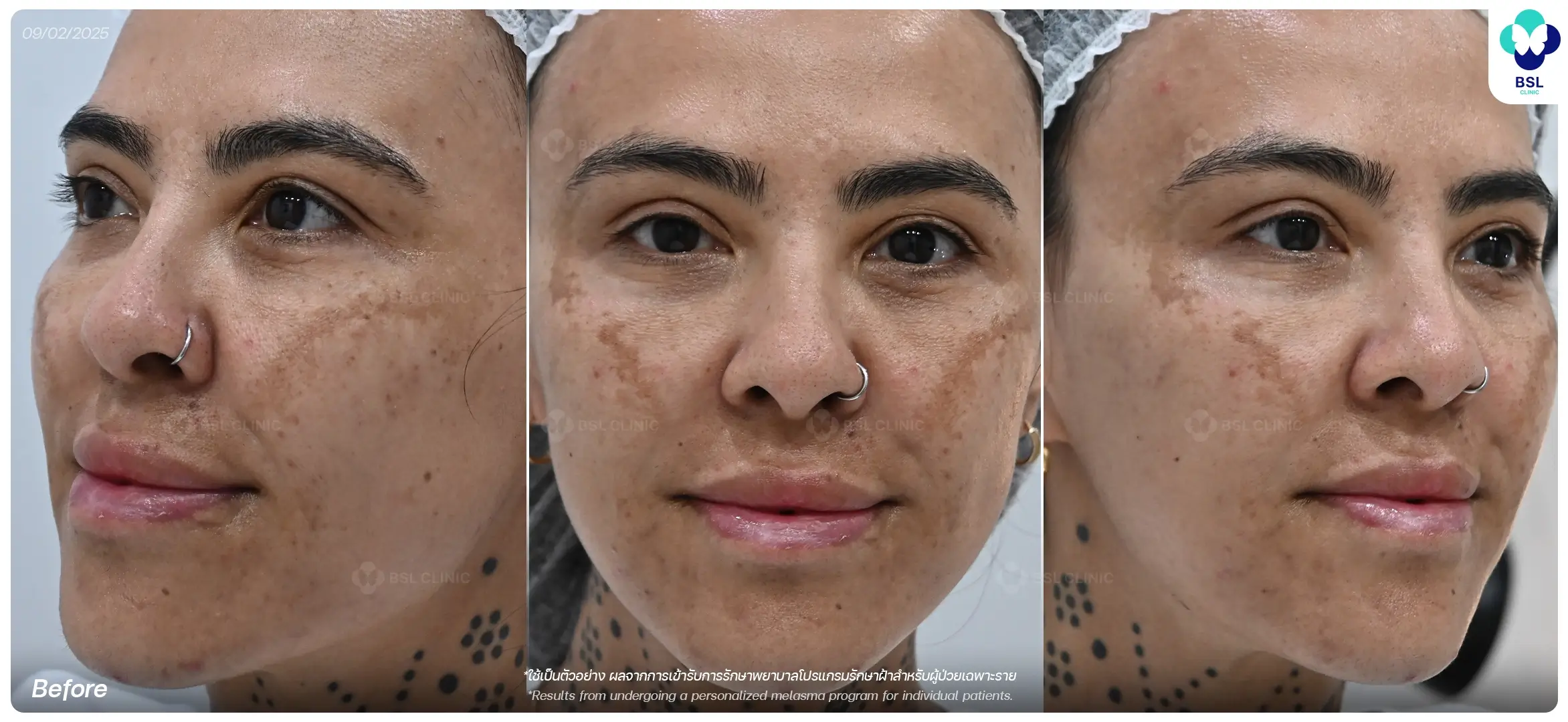 หลังรักษาฝ้า After Melasma Treatment