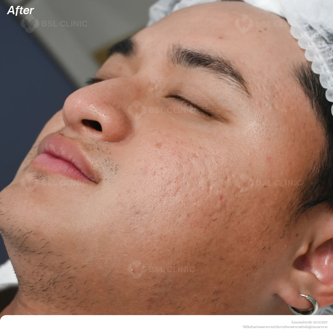 result-acne-treatment ผลลัพธ์รักษาสิว
