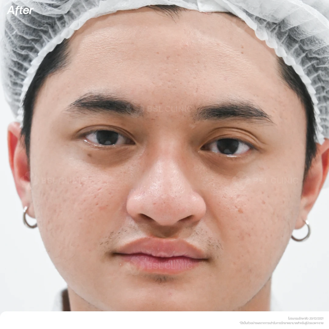 result-acne-treatment ผลลัพธ์รักษาสิว-A2