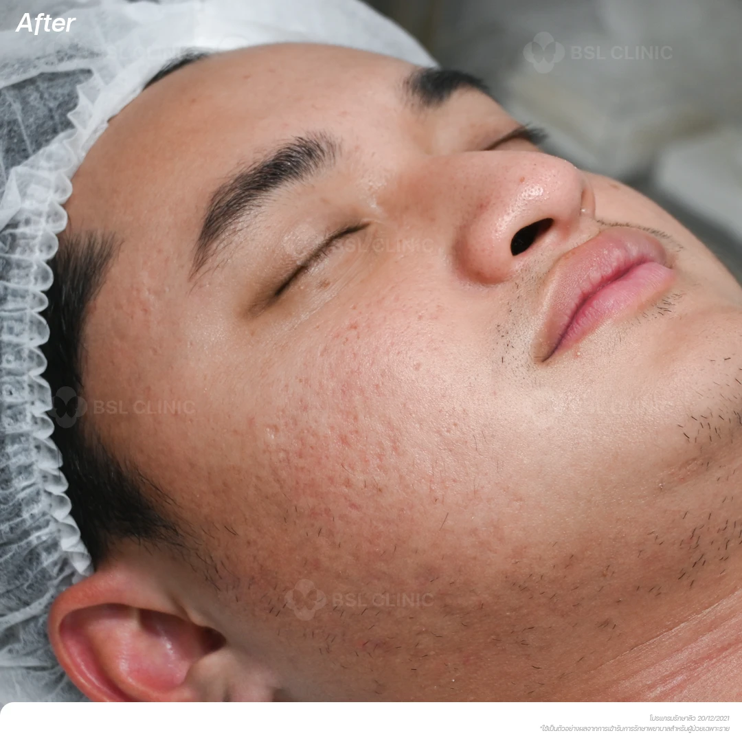 result-acne-treatment ผลลัพธ์รักษาสิว-A3