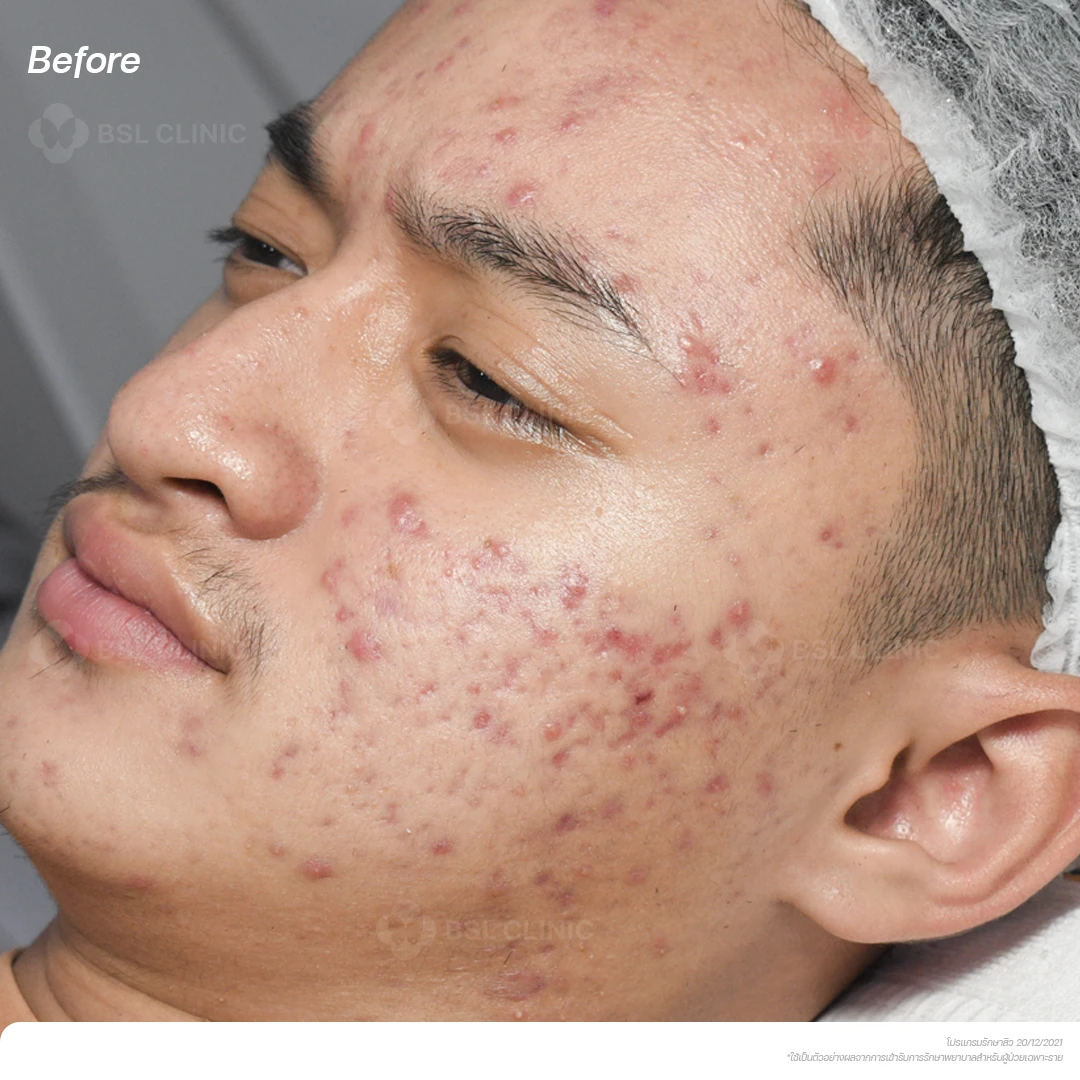 result-acne-treatment ผลลัพธ์รักษาสิว-B1
