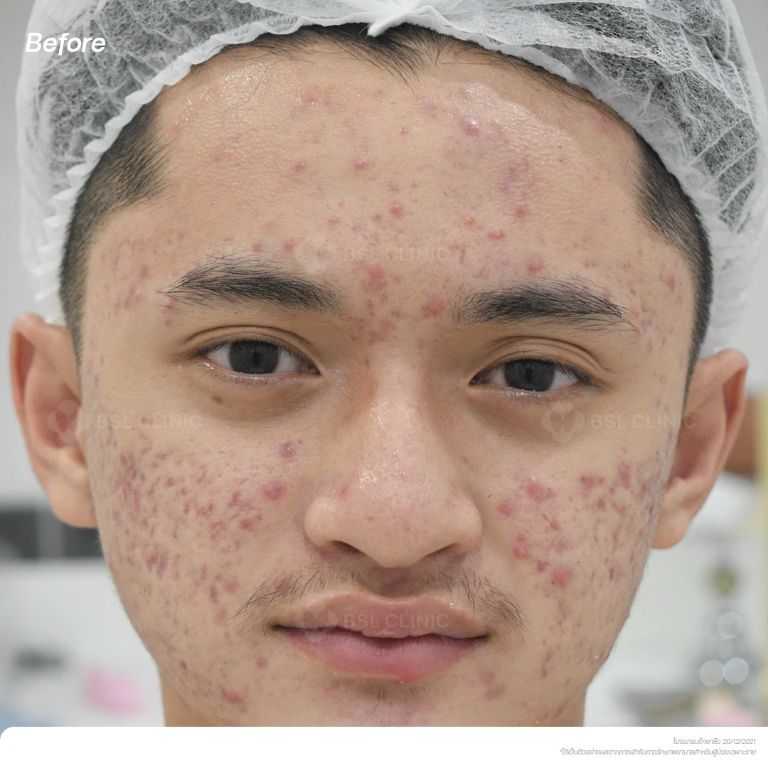 result-acne-treatment ผลลัพธ์รักษาสิว