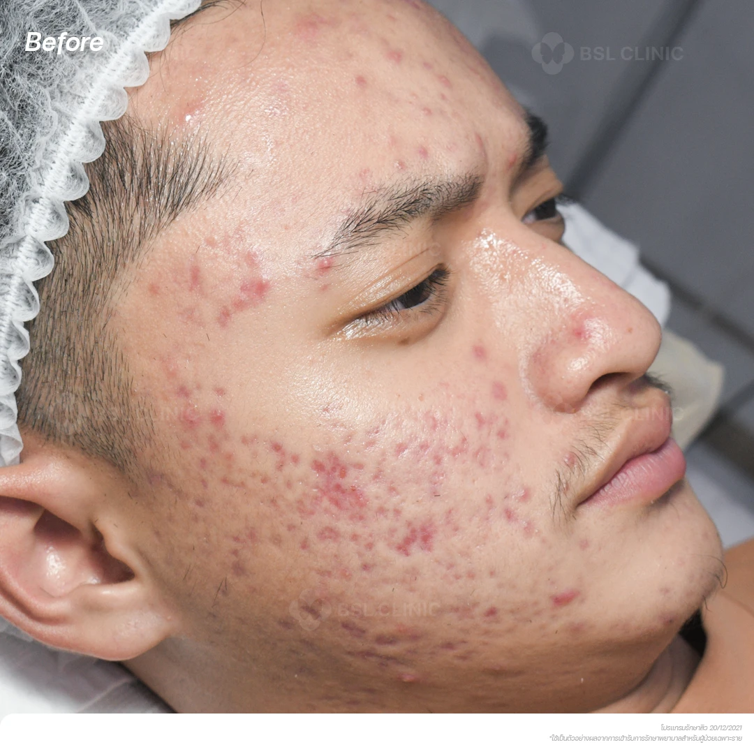 result-acne-treatment ผลลัพธ์รักษาสิว