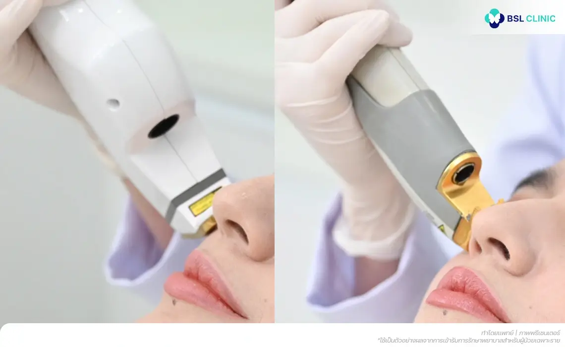 ดูแลปัญหาสิว Acne Treatment