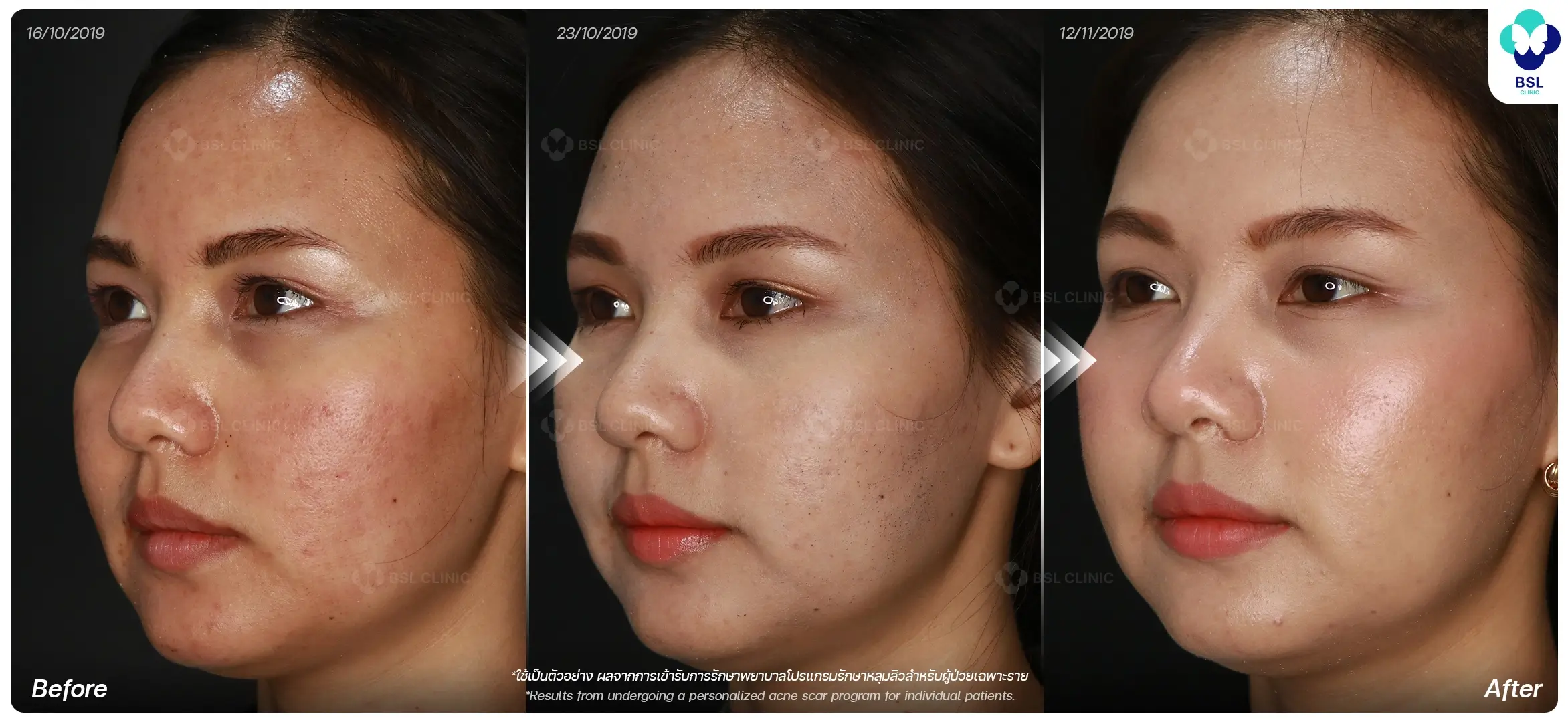 ผลลัพธ์หลังทำ Pico Laser Program Timeline Recovery Pico Laser Program