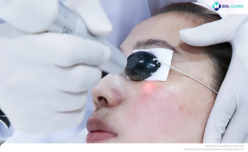 Revlite / Lutronic Laser Program